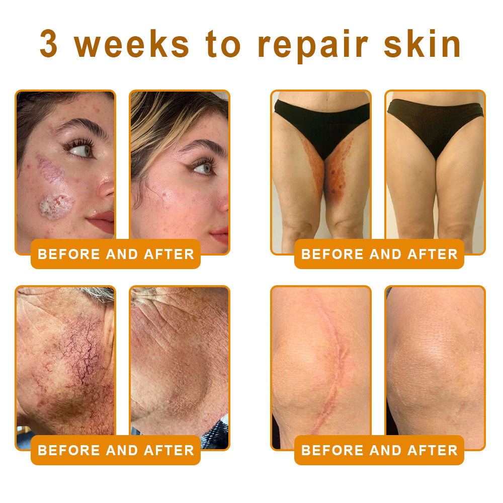 SEAGRIL®  𝐁𝐞𝐞 𝐏𝐨𝐢𝐬𝐨𝐧 𝐀𝐥𝐥-𝐢𝐧-𝐎𝐧𝐞 𝐂𝐫𝐞𝐚𝐦–🌸 Anti-aging,Hydrating, Skin Repair, Even Tone, Acne and Dark Spot Treatment, Wart and Mole Removal, Psoriasis Relief