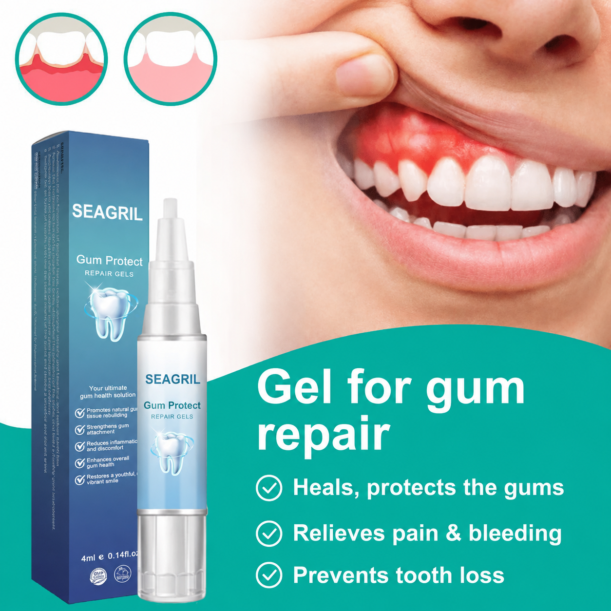 SEAGRIL — Stop Gum Recession and Bleeding Without Painful Surgery