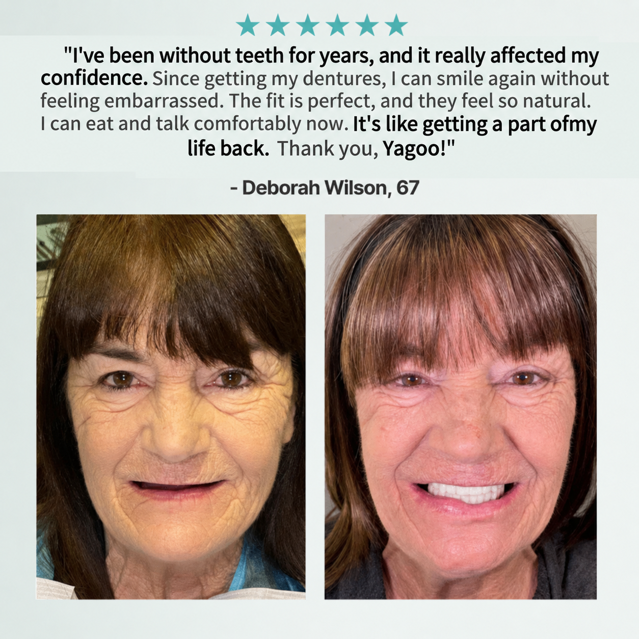 🌎Ends Today: 70% OFF! ⏰Yagoo™ Medical Full Denture with Strong Suctiond🦷Obtain American Dental Association (ADA) Certification