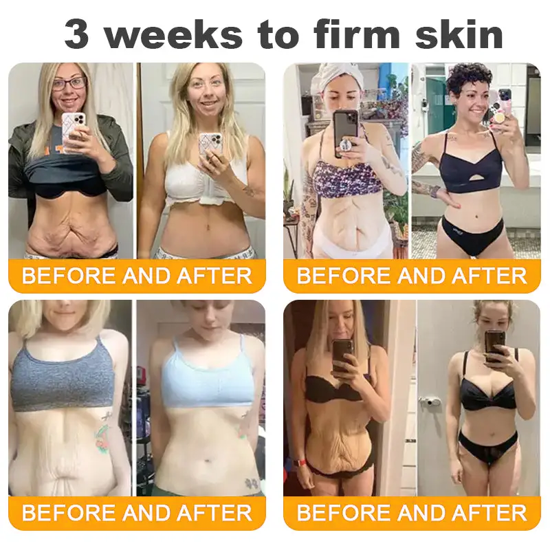 SEAGRIL®  𝐁𝐞𝐞 𝐏𝐨𝐢𝐬𝐨𝐧 𝐀𝐥𝐥-𝐢𝐧-𝐎𝐧𝐞 𝐂𝐫𝐞𝐚𝐦–🌸 Anti-aging,Hydrating, Skin Repair, Even Tone, Acne and Dark Spot Treatment, Wart and Mole Removal, Psoriasis Relief