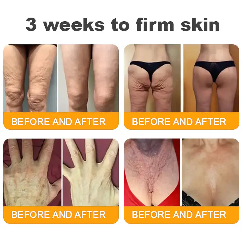 SEAGRIL®  𝐁𝐞𝐞 𝐏𝐨𝐢𝐬𝐨𝐧 𝐀𝐥𝐥-𝐢𝐧-𝐎𝐧𝐞 𝐂𝐫𝐞𝐚𝐦–🌸 Anti-aging,Hydrating, Skin Repair, Even Tone, Acne and Dark Spot Treatment, Wart and Mole Removal, Psoriasis Relief