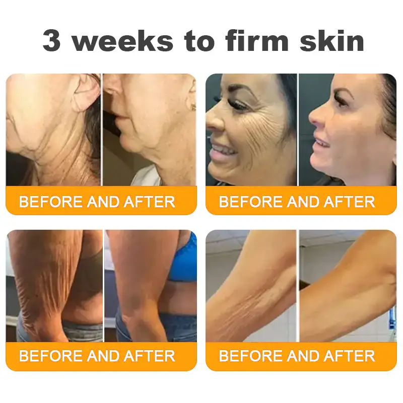 SEAGRIL®  𝐁𝐞𝐞 𝐏𝐨𝐢𝐬𝐨𝐧 𝐀𝐥𝐥-𝐢𝐧-𝐎𝐧𝐞 𝐂𝐫𝐞𝐚𝐦–🌸 Anti-aging,Hydrating, Skin Repair, Even Tone, Acne and Dark Spot Treatment, Wart and Mole Removal, Psoriasis Relief
