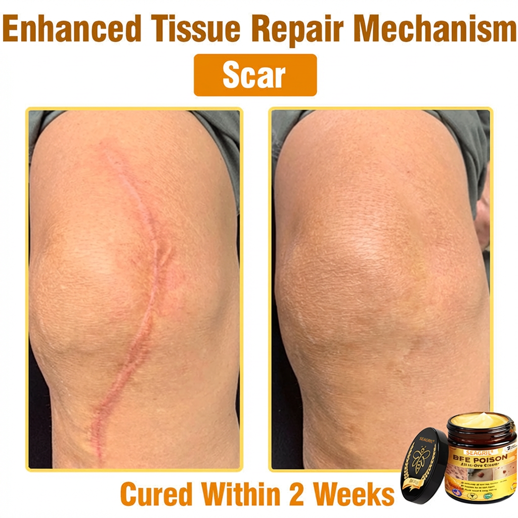 SEAGRIL®  𝐁𝐞𝐞 𝐏𝐨𝐢𝐬𝐨𝐧 𝐀𝐥𝐥-𝐢𝐧-𝐎𝐧𝐞 𝐂𝐫𝐞𝐚𝐦–🌸 Anti-aging,Hydrating, Skin Repair, Even Tone, Acne and Dark Spot Treatment, Wart and Mole Removal, Psoriasis Relief