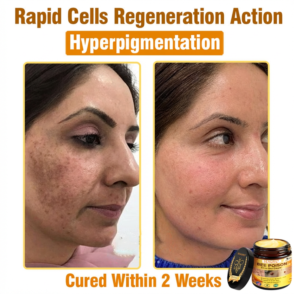 SEAGRIL®  𝐁𝐞𝐞 𝐏𝐨𝐢𝐬𝐨𝐧 𝐀𝐥𝐥-𝐢𝐧-𝐎𝐧𝐞 𝐂𝐫𝐞𝐚𝐦–🌸 Anti-aging,Hydrating, Skin Repair, Even Tone, Acne and Dark Spot Treatment, Wart and Mole Removal, Psoriasis Relief